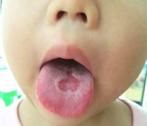Mách mẹ cách nhìn lưỡi đoán bệnh trẻ cực chuẩn 41 Mách mẹ cách nhìn lưỡi đoán bệnh trẻ cực chuẩn 13