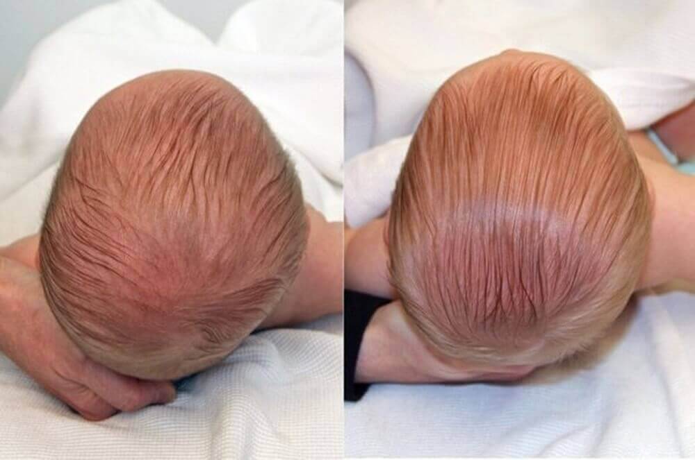 trẻ sơ sinh bị l&eacute;p đầu