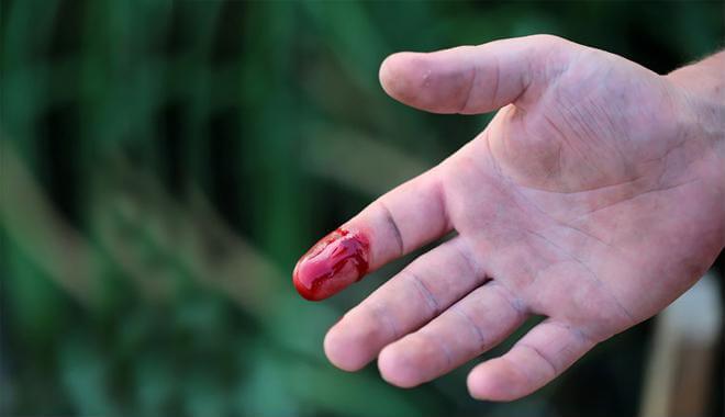 Mẹo hay xử lý vết thương chảy máu ngay tại nhà 36 Mẹo hay xử lý vết thương chảy máu ngay tại nhà 8