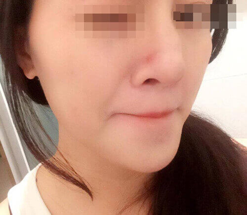 Mờ mắt sau 5 ngày nâng mũi bằng cách tiêm chất làm đầy 33 Mờ mắt sau 5 ngày nâng mũi bằng cách tiêm chất làm đầy 5