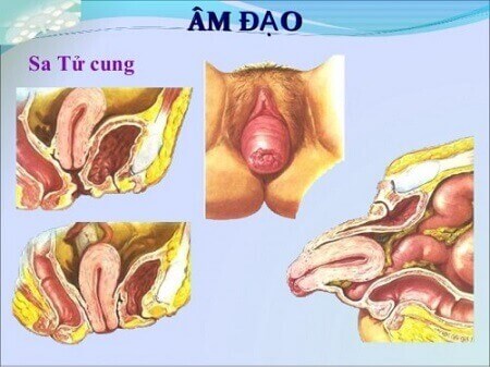 Sau sinh bị bệnh sa tử cung và cách chữa trị 33 Sau sinh bị bệnh sa tử cung và cách chữa trị 5