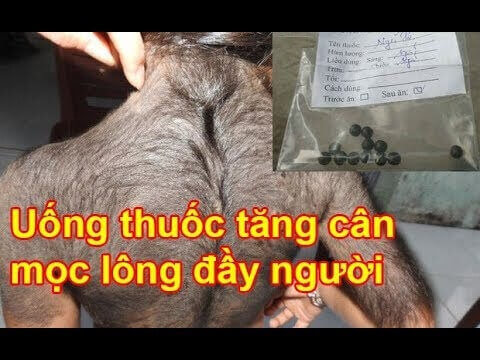 Uống thuốc tăng cân, bé gái 7 tuổi mọc lông khắp người 35 Uống thuốc tăng cân, bé gái 7 tuổi mọc lông khắp người 7