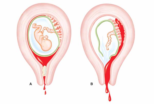 Vỡ tử cung tai biến sản khoa cực kỳ nguy hiểm cho mẹ bầu 35 Vỡ tử cung tai biến sản khoa cực kỳ nguy hiểm cho mẹ bầu 8
