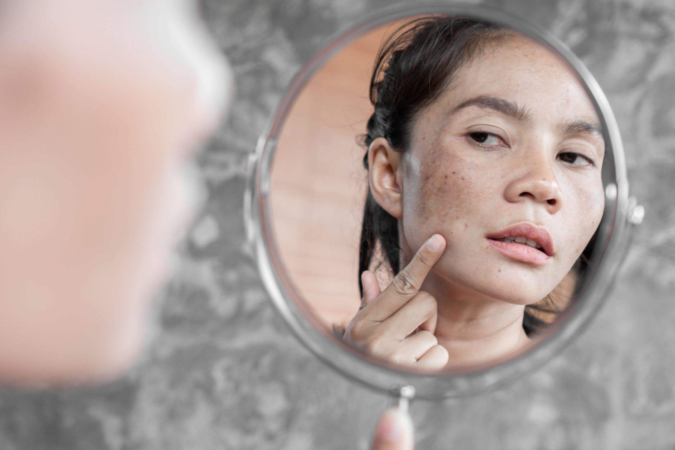 Mách mẹ 6 cách trị nám da khi mang thai và sau sinh hiệu quả 37 nám da khi mang thai