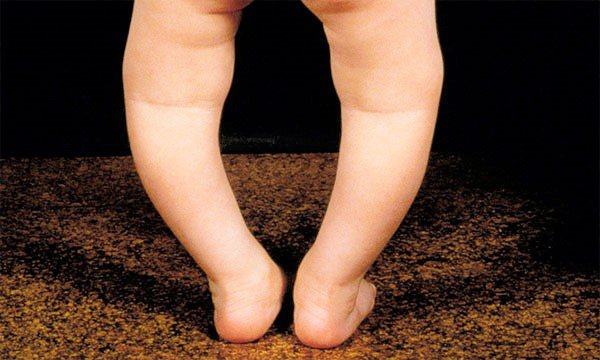 Phòng ngừa tật chân vòng kiềng ở trẻ 11