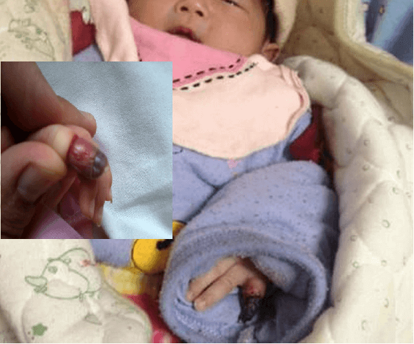Bé bị hoại tử ngón chân chỉ vì sợi tóc rụng của mẹ 8