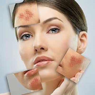 Nhận biết da bị nhiễm độc kim loại có trong các loại mỹ phẩm 3