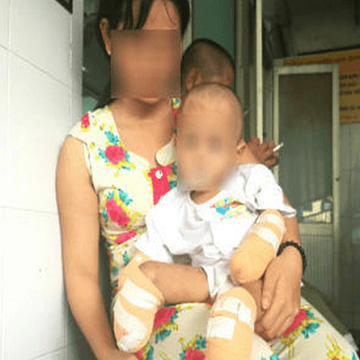 Tiền Giang: Viêm màng não mô cầu, bé 2 tuổi buộc phải đoạn chi 5