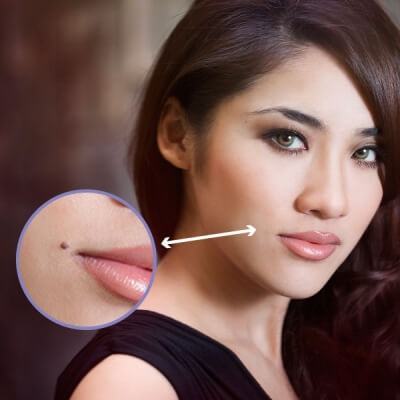 Tự tẩy nốt ruồi an toàn bằng phương pháp tự nhiên 3
