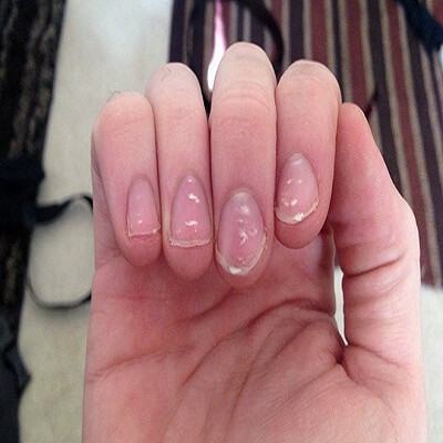 Đốm trắng trên móng tay báo hiệu điều gì? 6