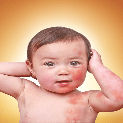 9dbnh1968891.png Dị ứng thức ăn