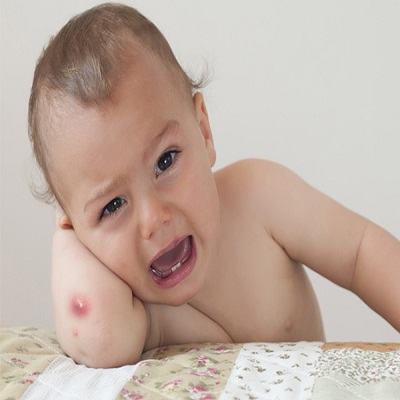 “Đuổi” mụn nhọt cho bé yêu bằng những bài thuốc dân gian dễ tìm 3