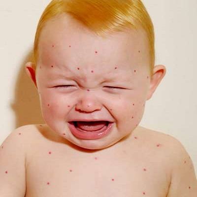 Các bệnh về da thường gặp vào hè và cách phòng tránh 3