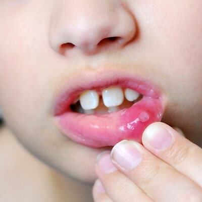 Chữa nhiệt miệng cho bé bằng 6 dược liệu tự nhiên có sẵn 6