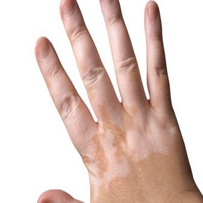 Cảnh giác với 7 căn bệnh ngoài da dễ lây nhiễm 3