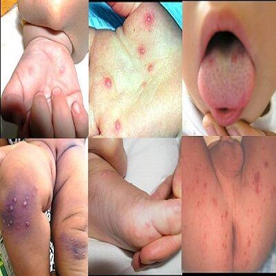 Bệnh tay chân miệng có nguy cơ bùng phát mùa tựu trường 5