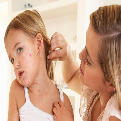 8 bài thuốc trị thủy đậu mà các mẹ có con nhỏ cần bỏ túi 7