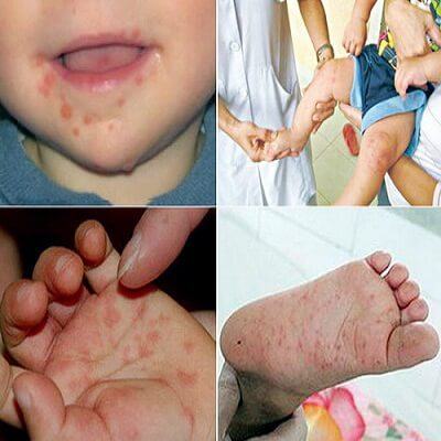Biện pháp phòng bệnh tay chân miệng tốt nhất cho trẻ 4