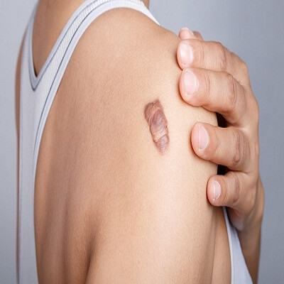 Bị sẹo nên ăn gì cho làn da nhanh trở lại bình thường? 5