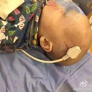 Bé 2 tuổi bị phích điện cắm vào đầu do ngã từ trên giường xuống 5