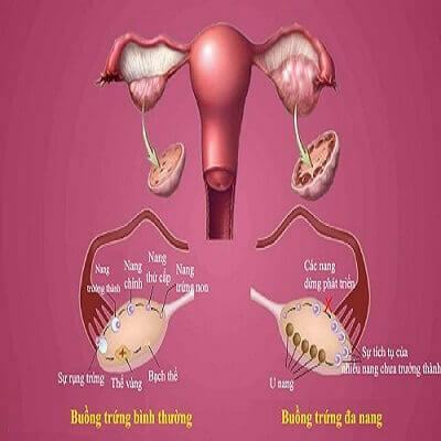 Đa nang buồng trứng, nguyên nhân hàng đầu dẫn đến vô sinh 6