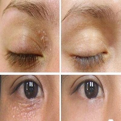 Tự làm kem trị mụn thịt, hiệu quả chưa từng thấy 6