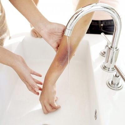 Phân loại phỏng và cách sơ cứu khi bé bị phỏng 5