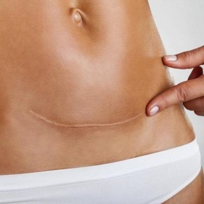 8 bí quyết khiến sẹo lồi sau sinh mổ phải "chào thua" mẹ đây! 3