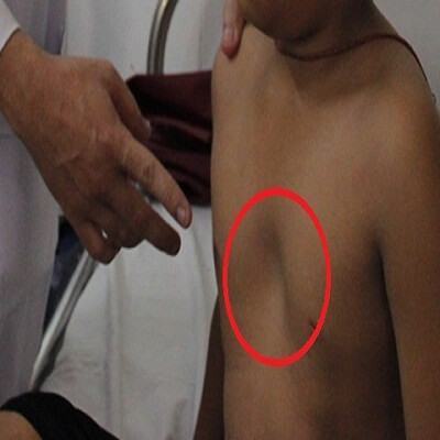 Kiểm tra xem con bạn có bị chứng lõm ngực bẩm sinh không 5