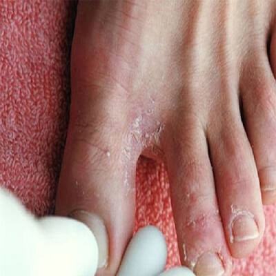 Chỉ cần những nguyên liệu này có sẵn trong nhà sẽ không còn lo "nước ăn chân" 3
