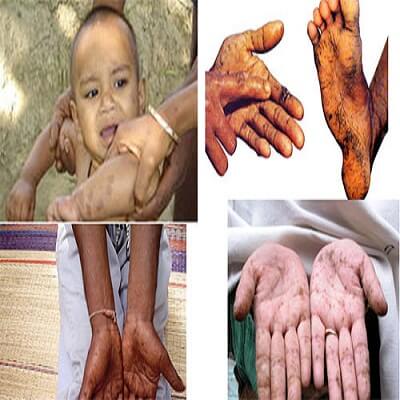 Nhận biết và phòng tránh nhiễm độc chì cho bé 5