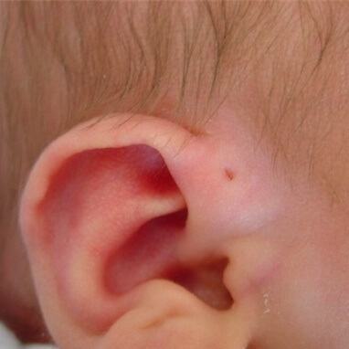 Có phải trẻ sinh ra với lỗ nhỏ trên vành tai sẽ thông minh xuất chúng? 5