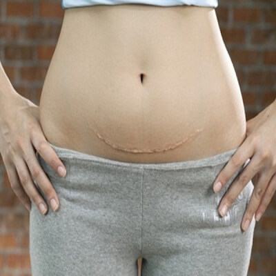 Nguy hiểm khôn lường khi thai bám ở vết sẹo sinh mổ 3