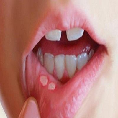 “Đuổi” nhiệt miệng nhanh cho bé bằng các loại lá dễ tìm 3