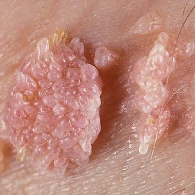 Thắc mắc tế nhị: Bệnh sùi mào gà có chữa được không? 5