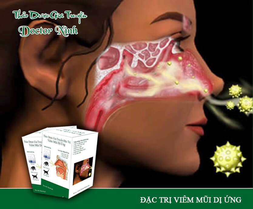Thảo dược gia truyền Doctor Ninh đặc trị viêm mũi dị ứng 6