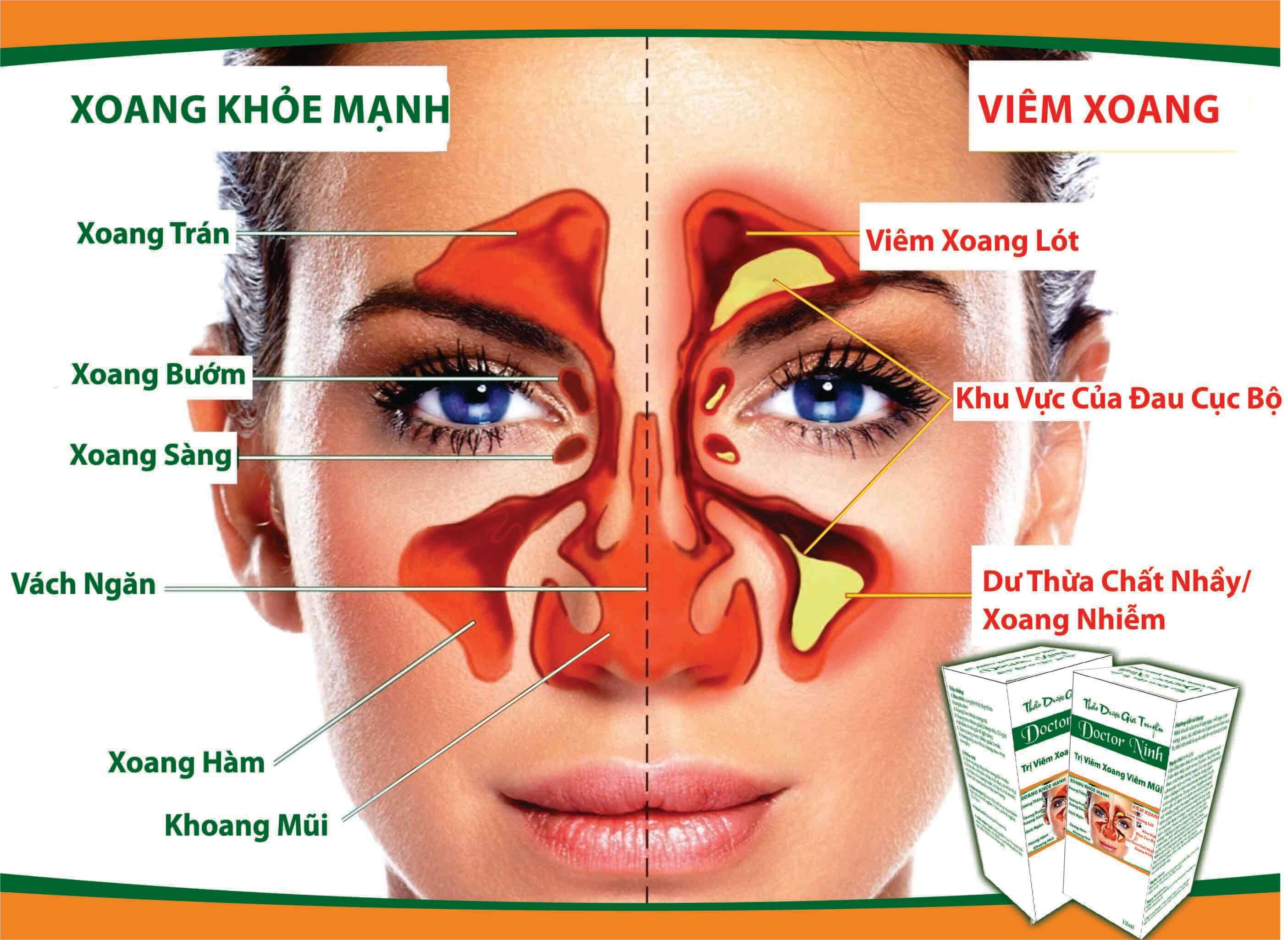 viêm xoang 