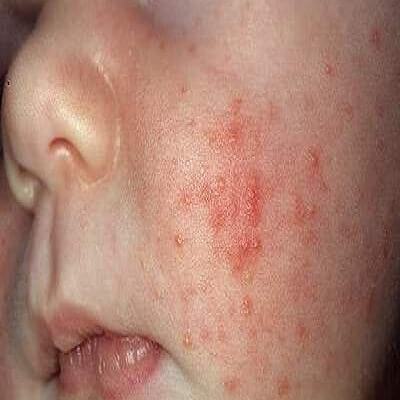 Trẻ sơ sinh bị kê và mẹo hay cho mẹ 5