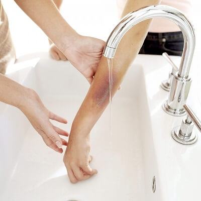 Cách chữa bỏng cho trẻ em đúng và hiệu quả 4