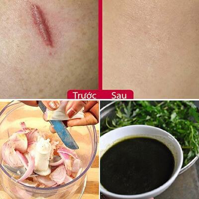 3 công thức "thần thánh" trị sẹo lồi, sẹo thâm với giá rẻ bèo 3