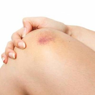 11 cách chữa lành vết bầm tím hiệu quả tại nhà 6