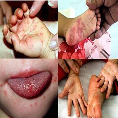 Bé bị tay chân miệng phải làm sao để nhanh khỏi bệnh 5