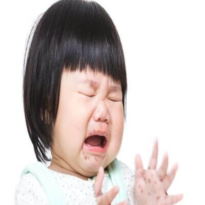Trẻ bị bệnh tay chân miệng có nguy hiểm không? 3