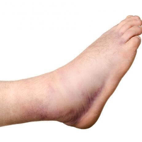 Mách mẹ cách chữa bong gân nhẹ ngay tại nhà 4