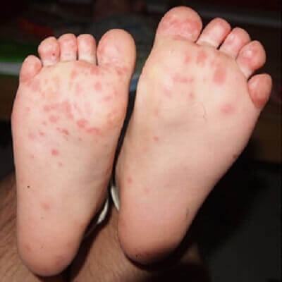 Các bệnh mùa hè thường gặp ở trẻ và cách phòng tránh 3