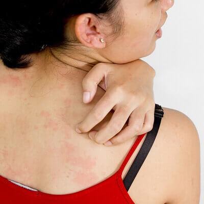 Cách chữa dị ứng hải sản hiệu quả chẳng cần thuốc 3