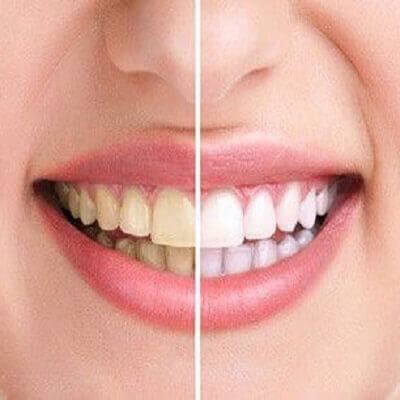 Cách làm sạch cao răng tại nhà hiệu quả như đi nha khoa 3