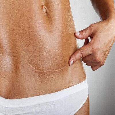 Nhận biết những dấu hiệu nhiễm trùng vết mổ sau sinh 4
