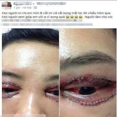 Theo đuổi trào lưu nhấn mí, đôi mắt cô gái bị biến dạng thảm hại 4