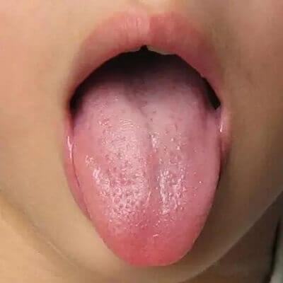 Mách mẹ cách nhìn lưỡi đoán bệnh trẻ cực chuẩn 8